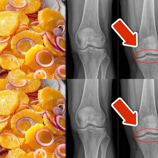 8 Super Easy Ways to Strengthen Your Knees, Cartilage, and Ligaments Using an Orange and Red Onion Mix