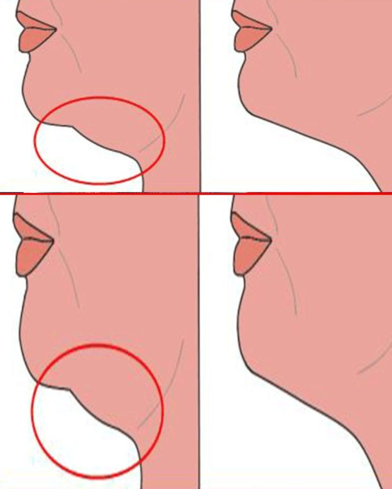 Ćwiczenia na podwójny podbródek – dowiedz się, jak pozbyć się podwójnego podbródka bez liposukcji podbródka