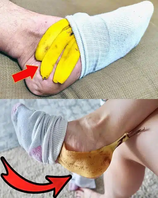 Peau de banane sur vos pieds : un remède naturel surprenant