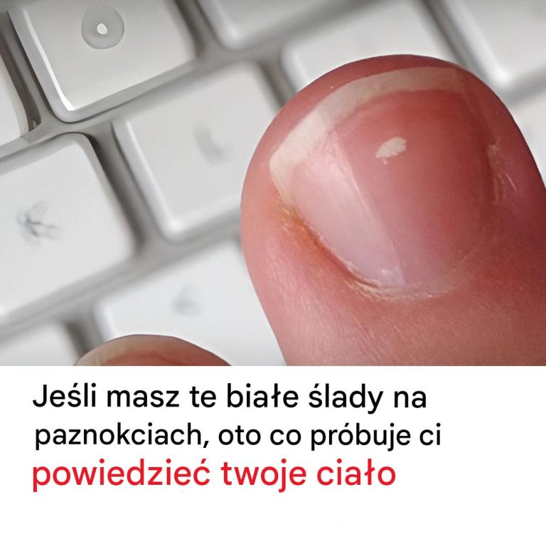 Dlaczego na paznokciach pojawiają się białe plamy?