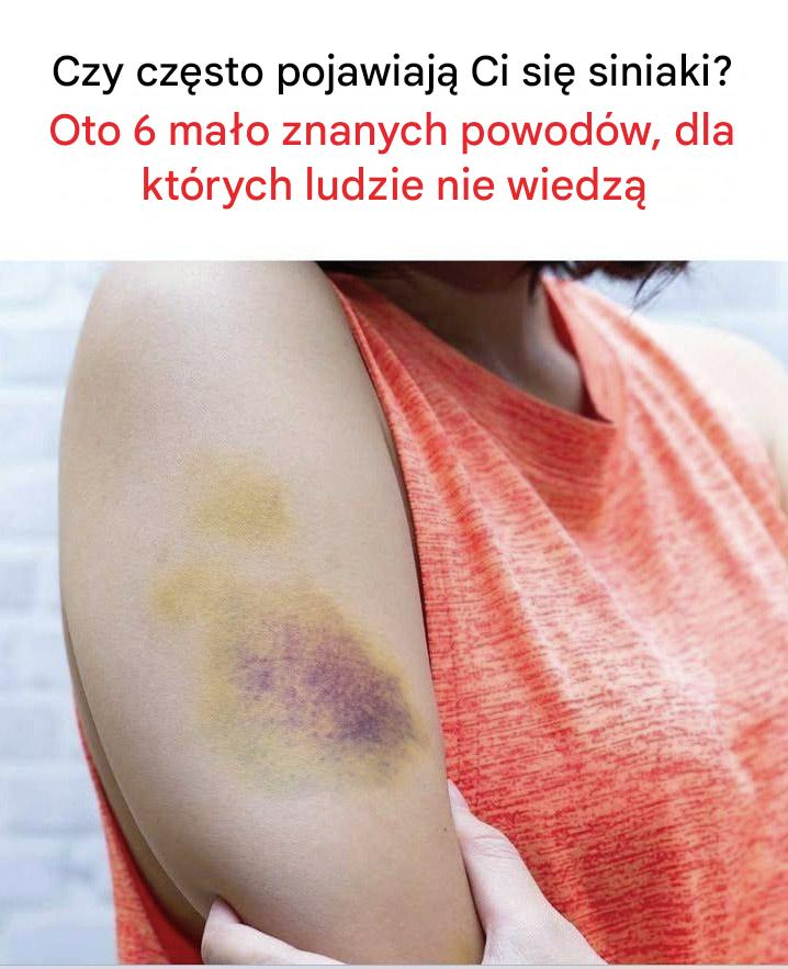 Czy często pojawiają Ci się siniaki? Oto 6 mało znanych powodów