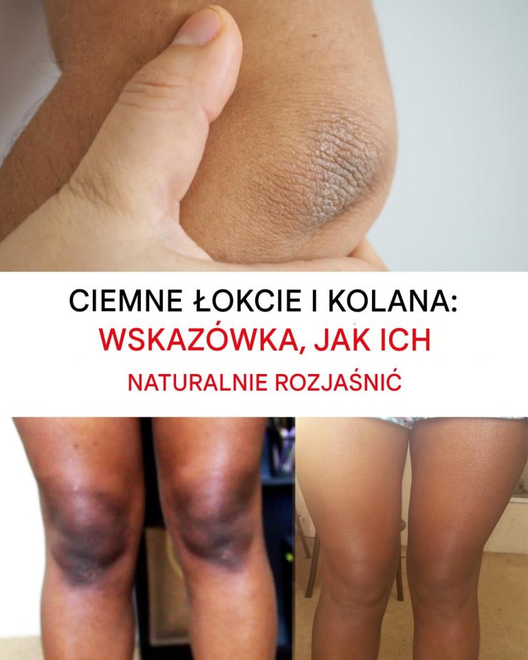 Jak naturalnie rozjaśnić ciemne łokcie i kolana?