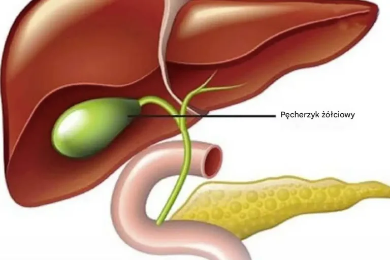 Co dzieje się w organizmie po usunięciu pęcherzyka żółciowego? 3 choroby, które mogą być tego wynikiem