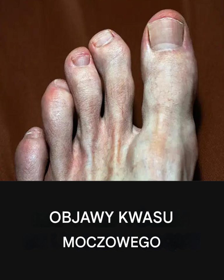 Dieta i kwas moczowy: produkty, których należy unikać, aby zapobiec dnie moczanowej