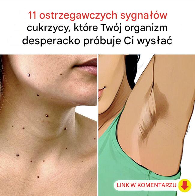 11 objawów cukrzycy, których nie należy ignorować: chroń swoje zdrowie!