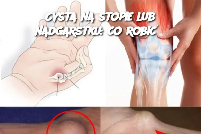 Cysta na stopie lub nadgarstku: co robić?