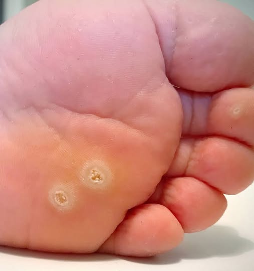 Mam szorstką, zgrubiałą skórę na stopach. Wkrótce nie będzie podiatry. Jakieś sposoby na zmniejszenie dyskomfortu?