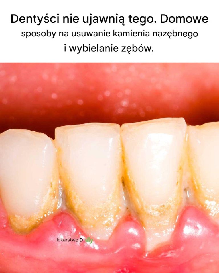Dentyści nie ujawnią tego. Domowe sposoby na usuwanie kamienia nazębnego i wybielanie zębów.