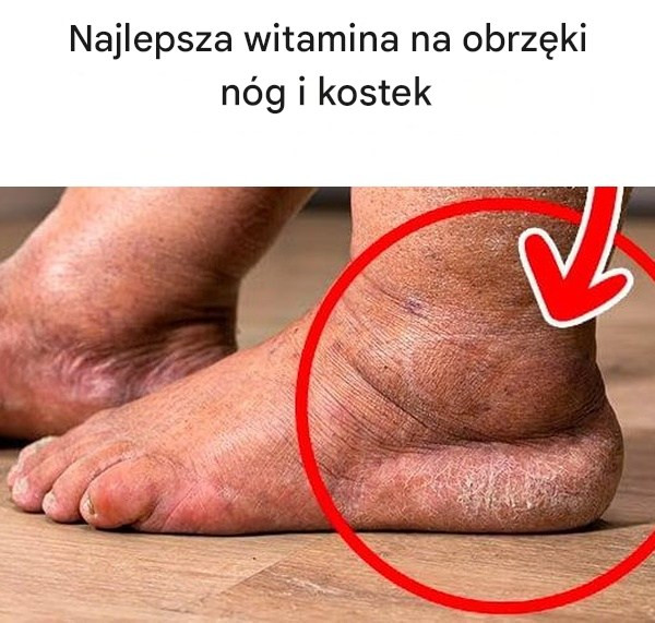 Naturalne wsparcie na opuchliznę nóg: domowa mieszanka witaminowa”