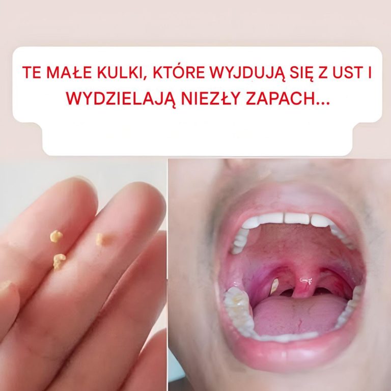 Nieświeży oddech: domowy sposób na świeży oddech