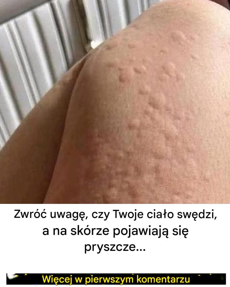 Dlaczego pokrzywka pojawia się na skórze? Oto zaskakujące czynniki, o których możesz nie wiedzieć
