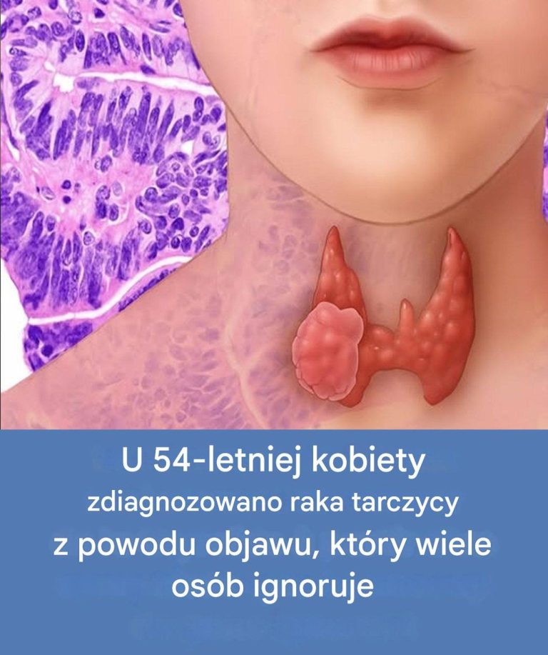 54-letnia kobieta dowiedziała się, że ma raka tarczycy, co często pozostaje niezauważone